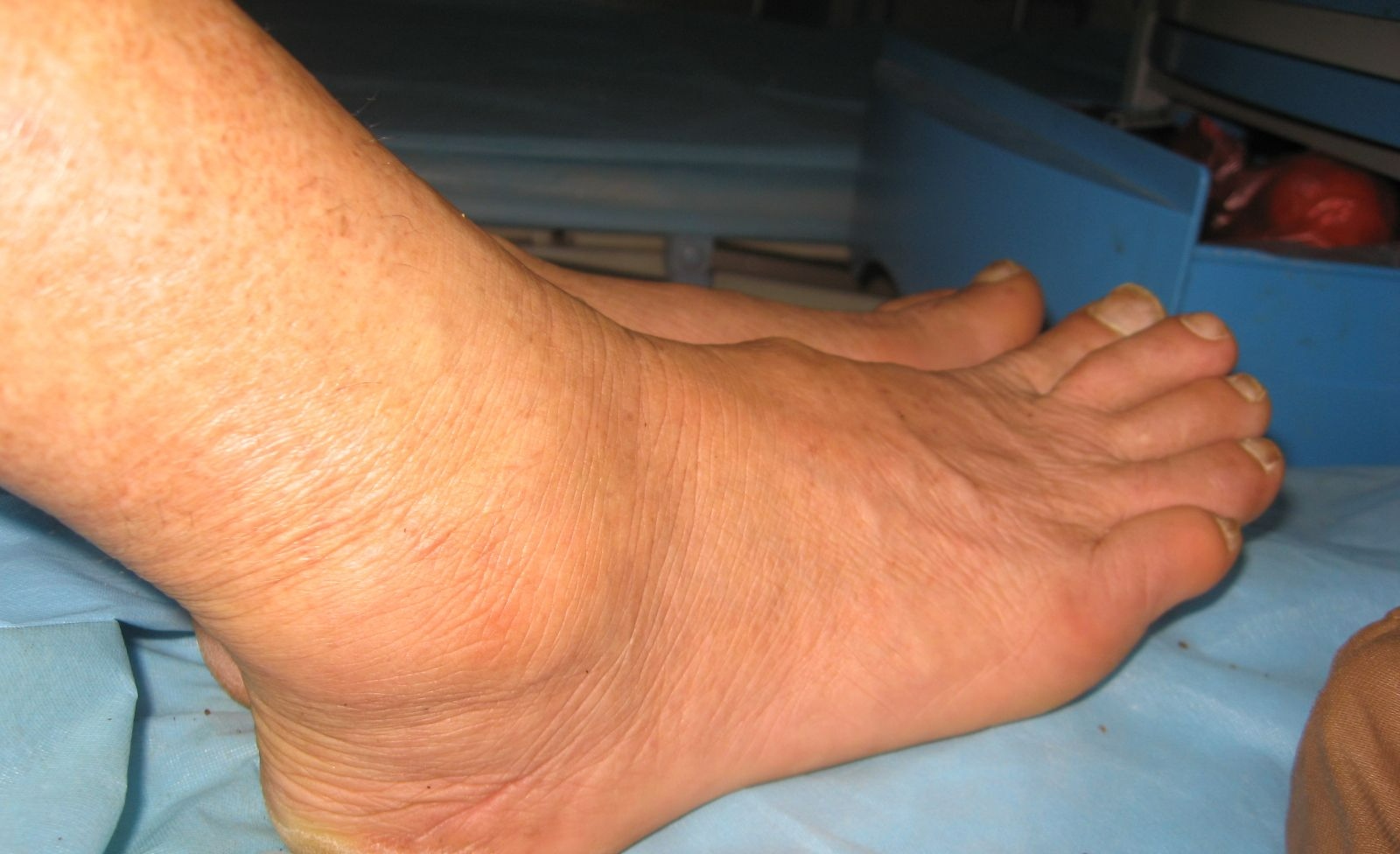 肢端肥大症可以发生在任何年龄,好发于中年,无明显性别差异