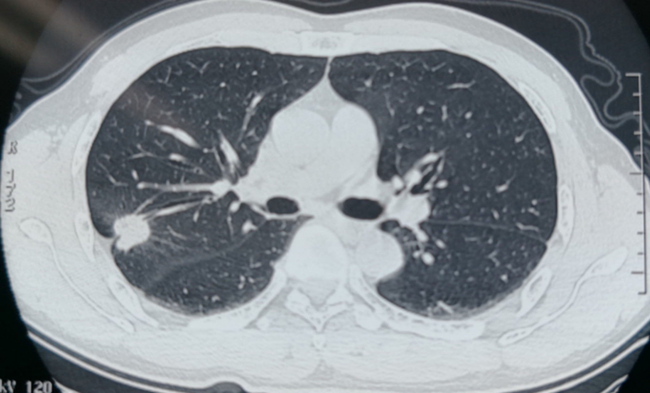 太揪心了,父亲确诊了肺癌晚期,脊柱转移,每天疼得唉唉叫.