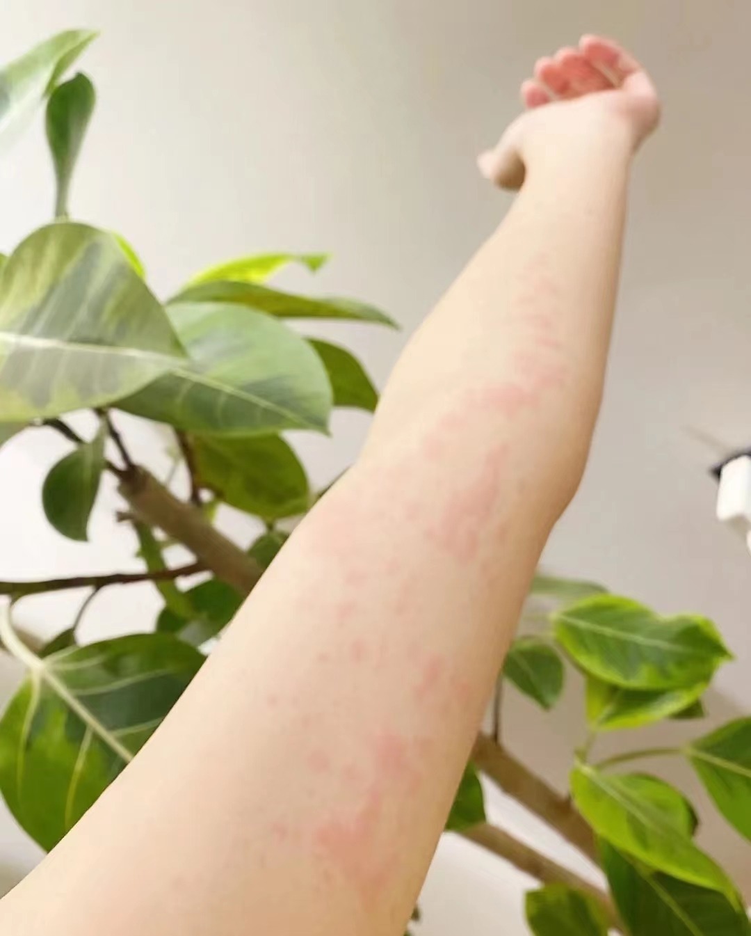 来看看老一辈去荨麻疹方法,一年多没反复