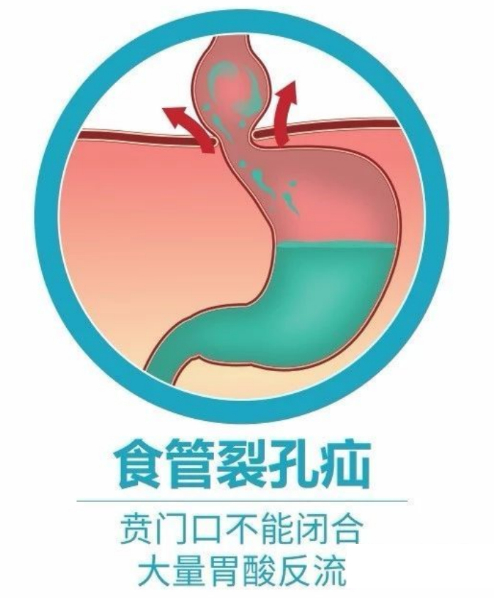 食管裂孔疝是什么病?应该如何治疗?医生详解治疗方案