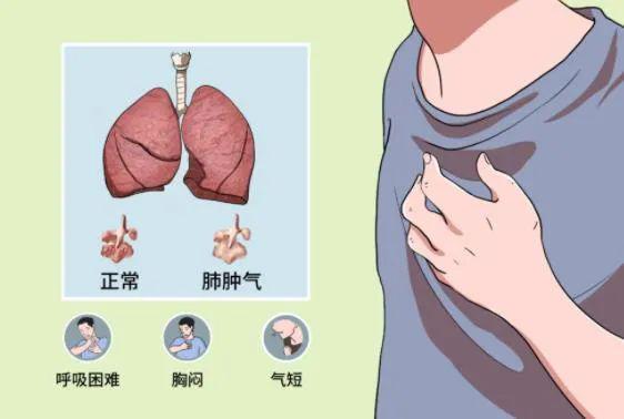 肺气肿可能与遗传因素有关,常见症状是呼吸困难和咳嗽