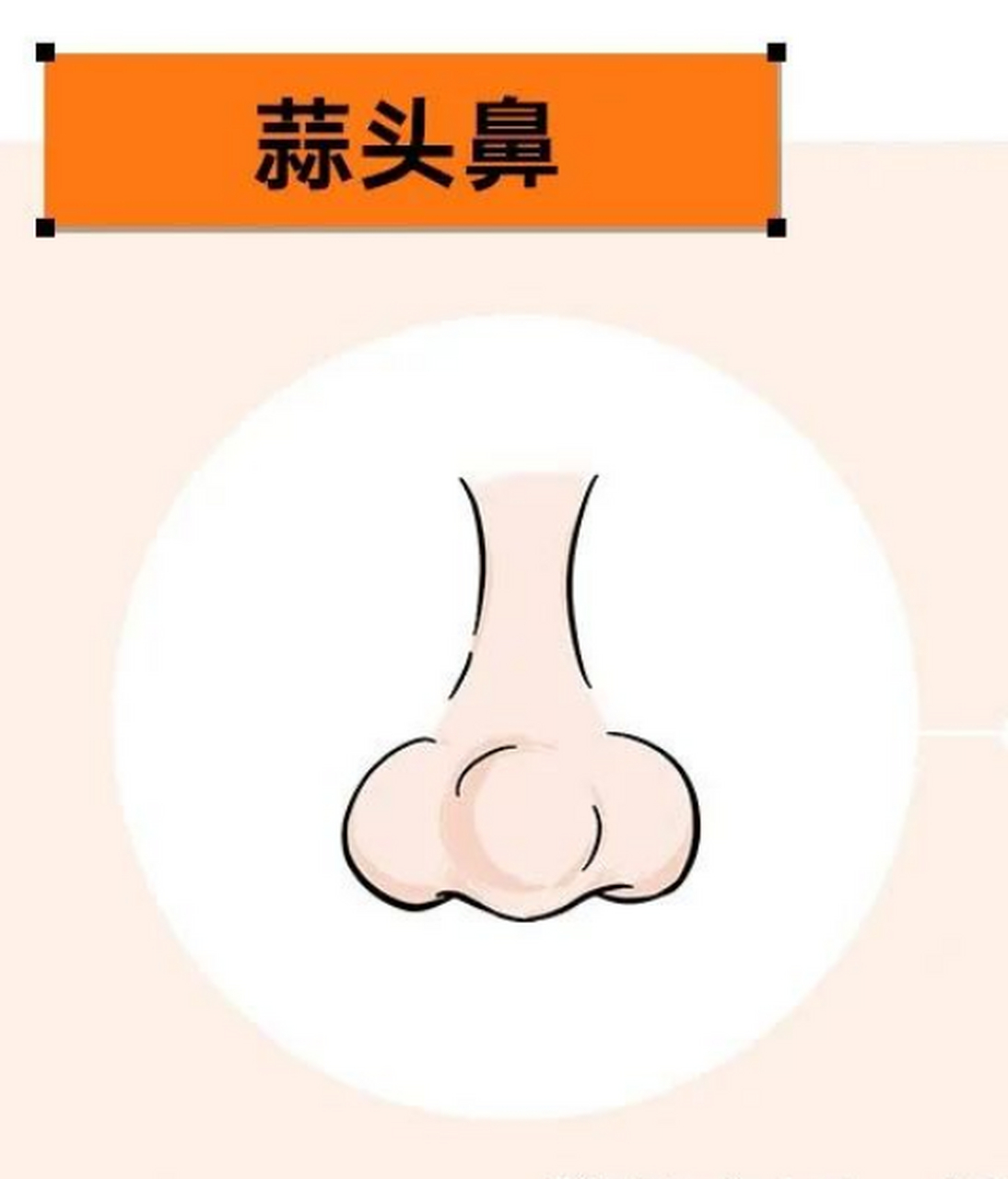 肉鼻头和蒜头鼻的区别 肉鼻头:只有鼻头部分肥大,宽厚,显得不够精致