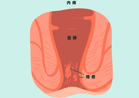 痔疮长什么样子的图片?内痔