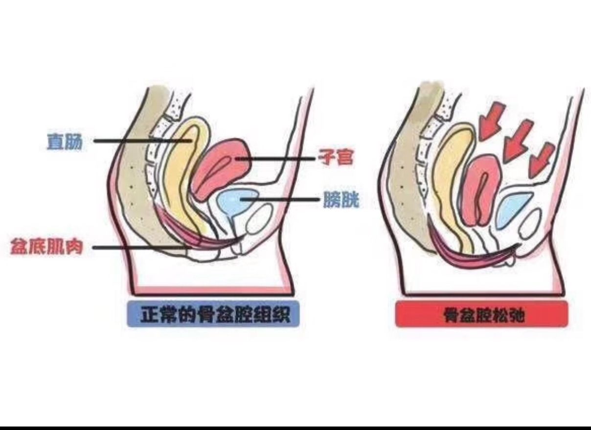 产后盆底肌紧