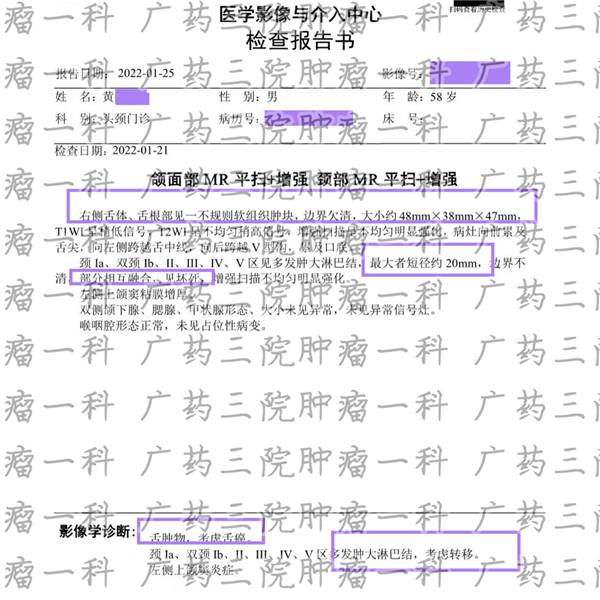 舌癌的治愈率是多少