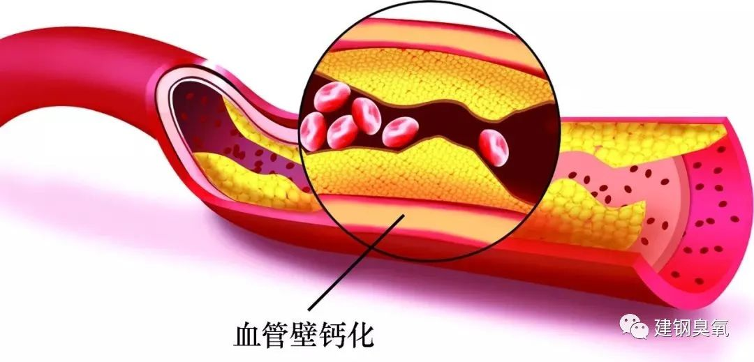 刘建钢教授:支架搭桥前先试下"臭氧"治疗