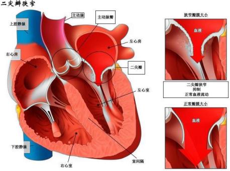 二尖瓣瓣环图图片