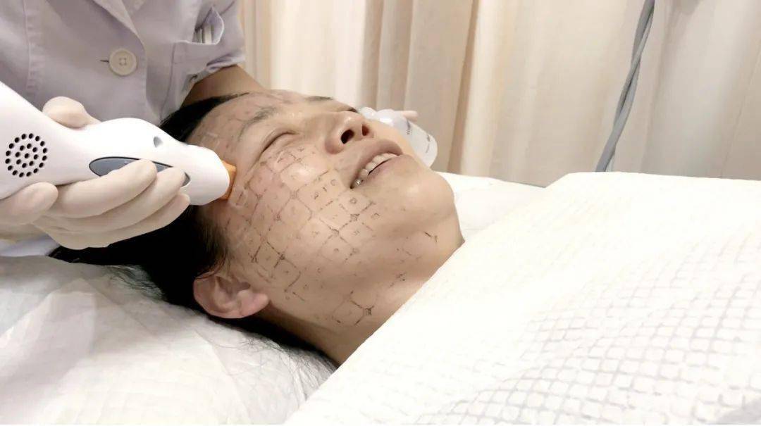 热玛吉手术流程为何如此热门,手术有风险吗?术后护理事项是什么