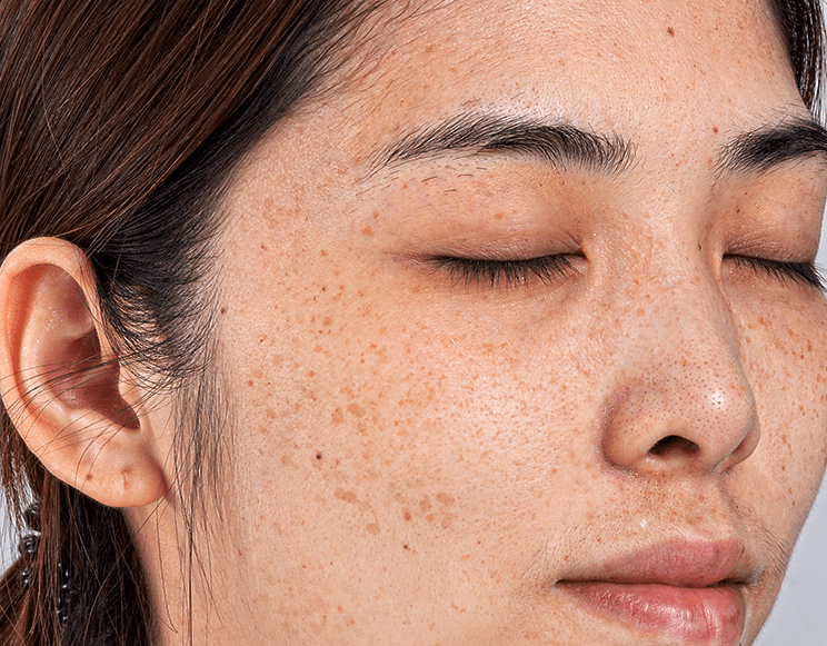 常见的几种色斑你知道吗,皮秒和超皮秒有何不同?