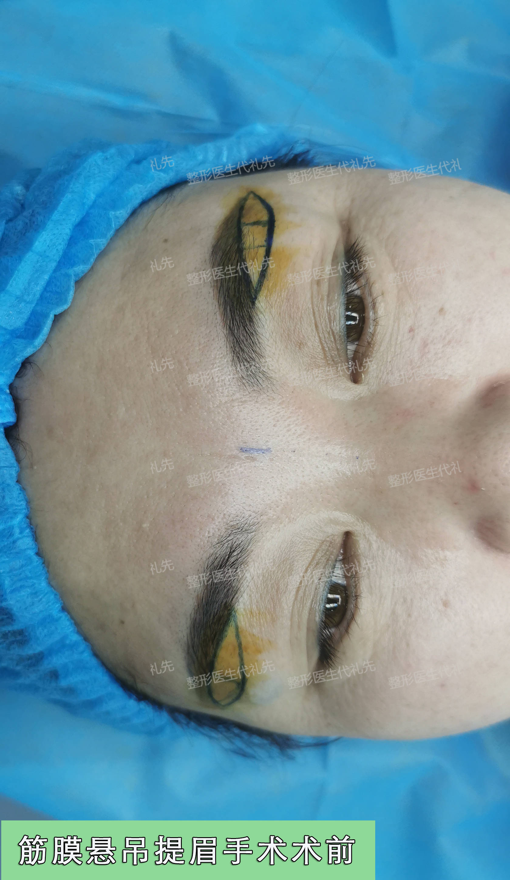 51岁女士终于下定决心把提眉手术做了术后眼睛变大变亮有精气神