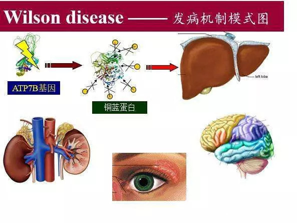 肝豆状核病变又称为wilson病,是一种常染色体隐性遗传疾病