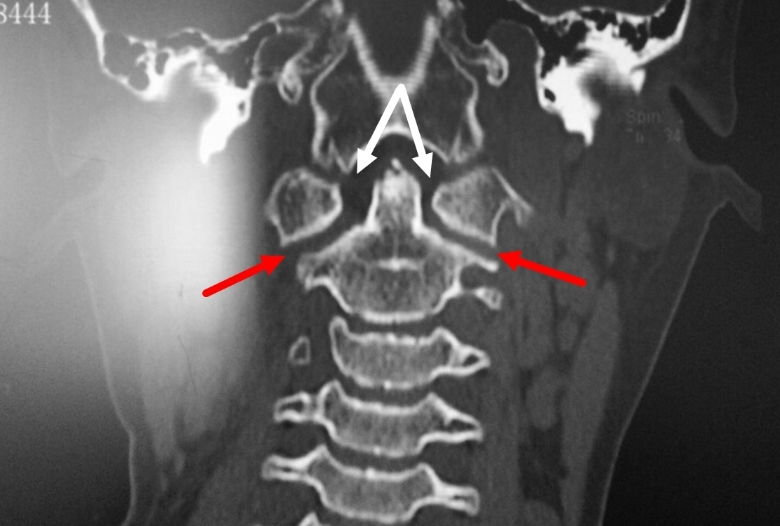 寰枢关节CT解剖图图片