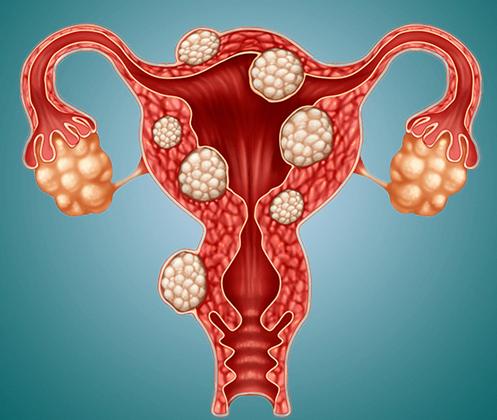 女性为什么容易长子宫肌瘤呢?医生提醒:尽量远离这5个行为