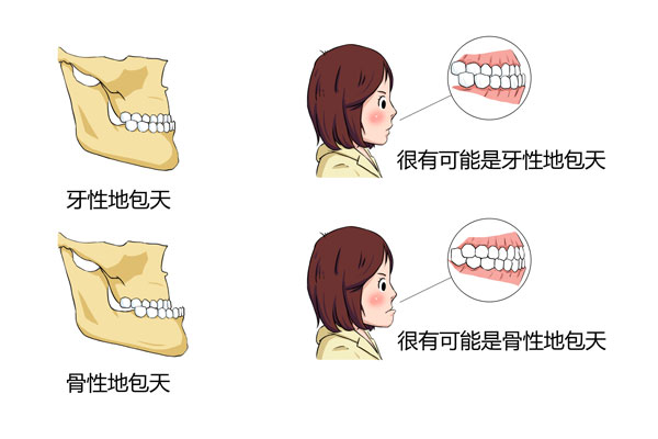 什么是地包天?有哪几类?解决方法有哪些?