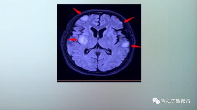 热点|女子一天吃一到两瓶辣酱还自行服胃药，两年半后大脑里“长毛”了
