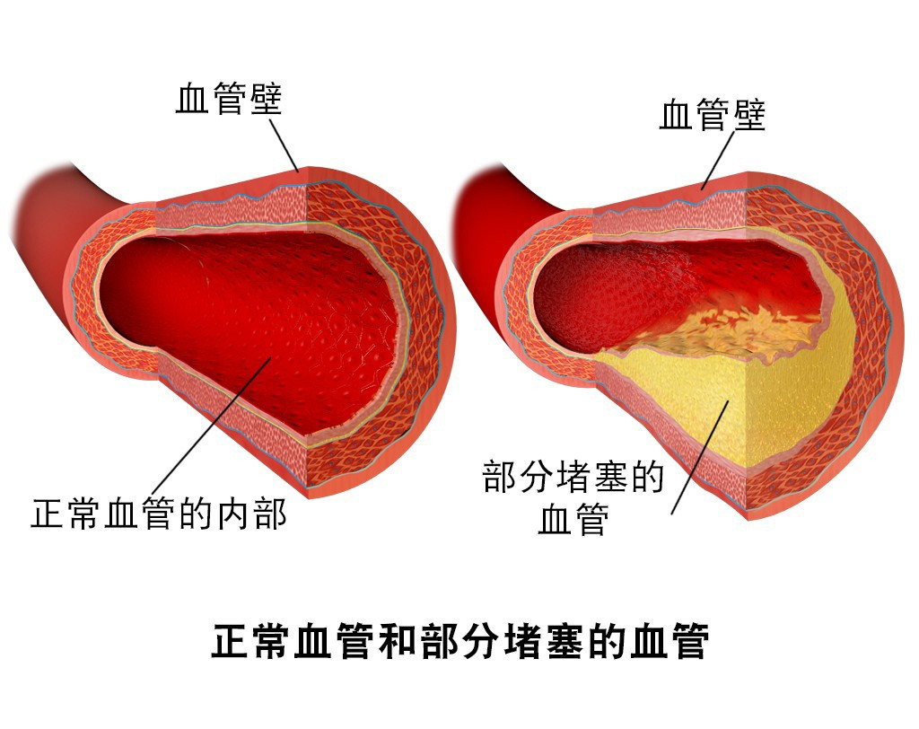 血管硬化身体常有哪些表现会出现心梗脑梗吗吃什么好