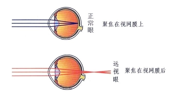 健康科普 了解远视怎么形成的?