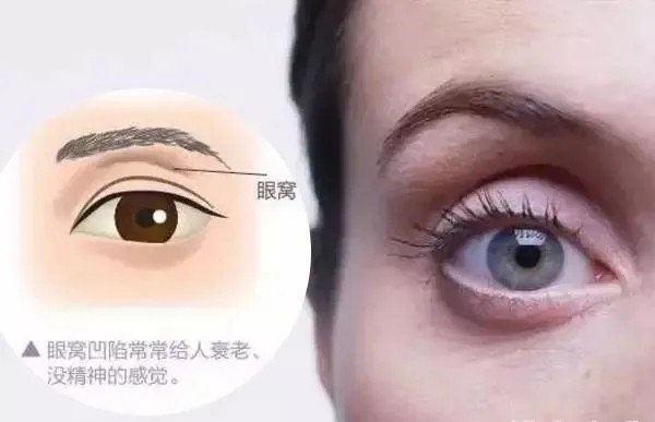 眼窝凹陷如何填补?医美方法很有效