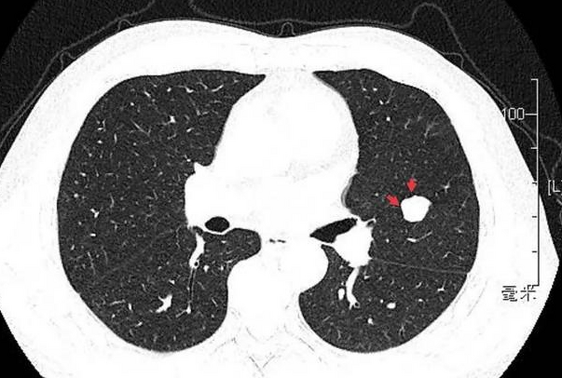 肺泡微石症:呼吸系统的罕见石化疾病  在我们的生活中,石化常常被与