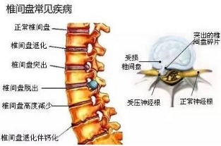 治療腰椎間盤突出西藥十大排名