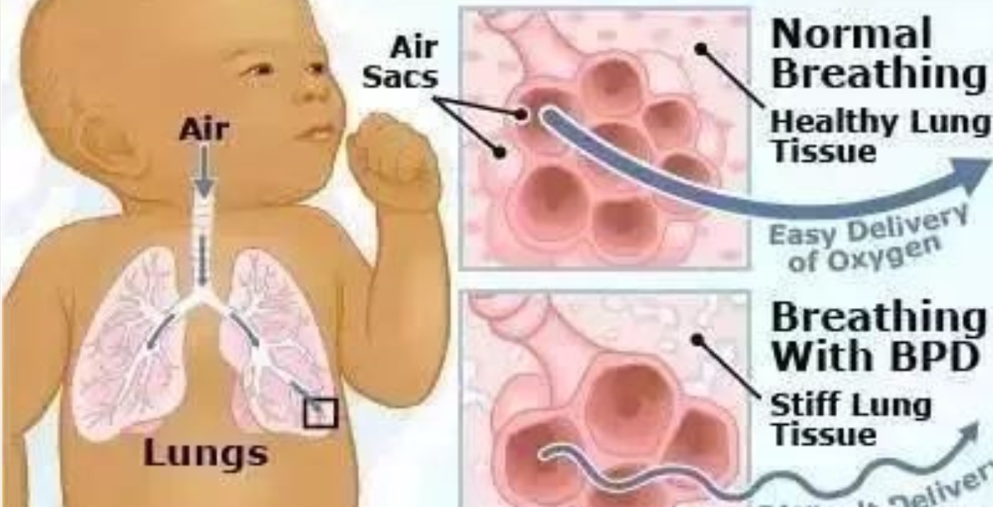 小儿支气管肺发育不全,本病治愈性很低,可能与遗传有关
