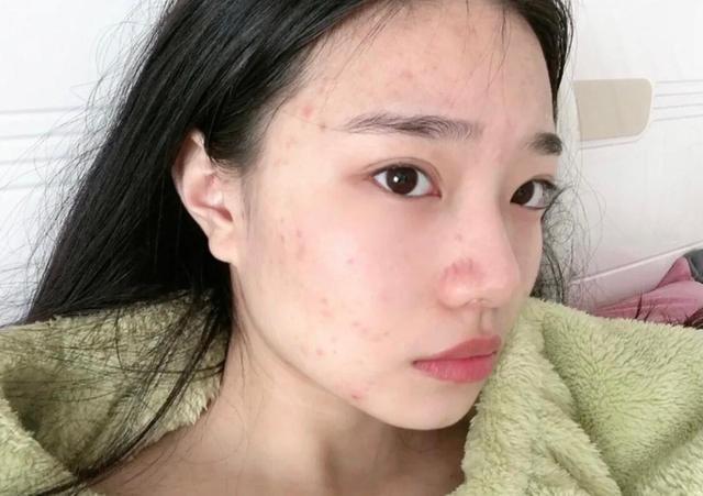 长了痘痘后"美女"变"丑女"?学会这3个小技巧,跟痘痘说拜拜
