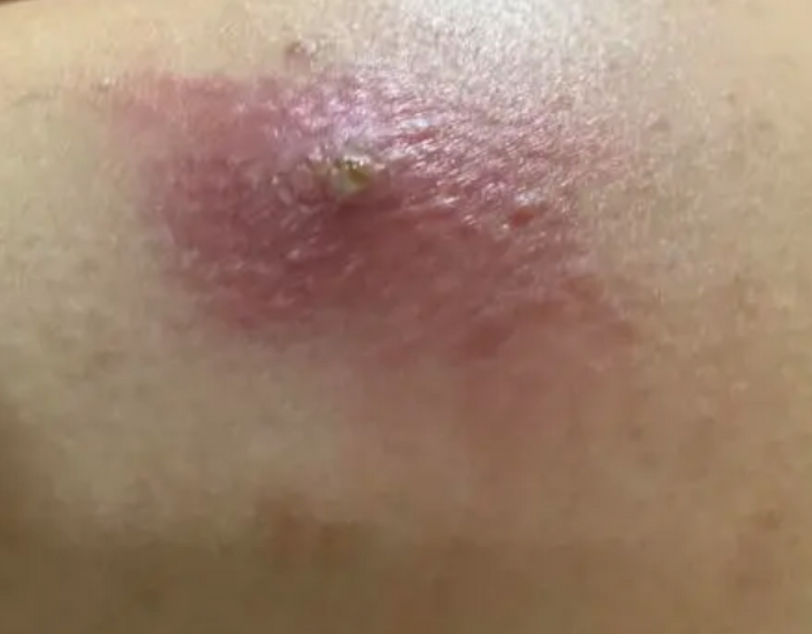 我妻子48岁,后背上长了个大疙瘩,不痛不痒的,感觉不是很严重,诊所医生