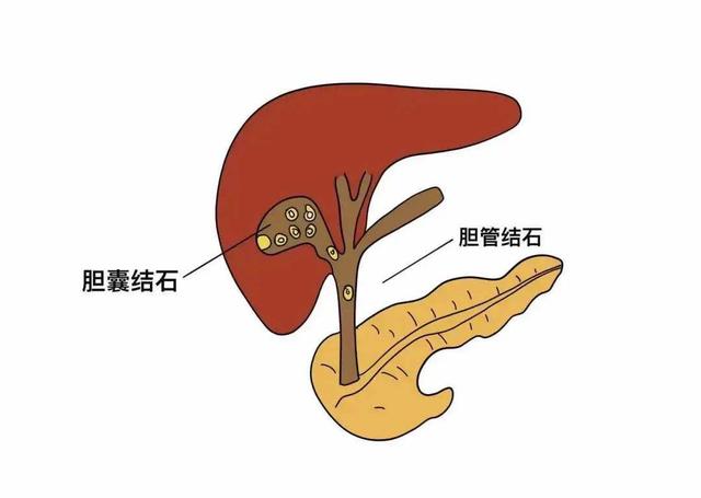 胆囊出现哪些问题需要切除?怎样保护胆囊健康?