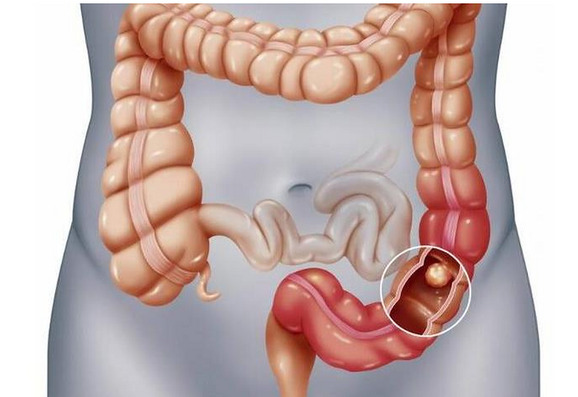 溃疡性结肠炎:了解病因,症状和治疗方法  今天我要和大家聊一聊一个