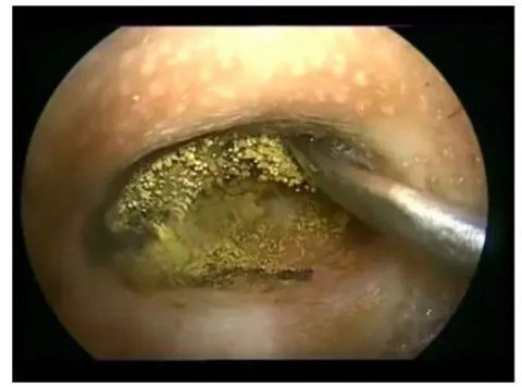 挖耳朵你真的会么?杭州大伯越挖越痒,耳朵里还长满了"毛"