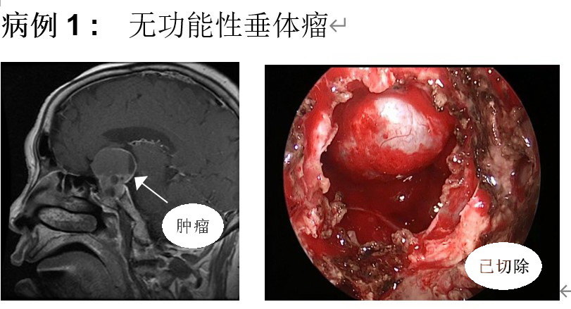 蝶窦 垂体瘤图片