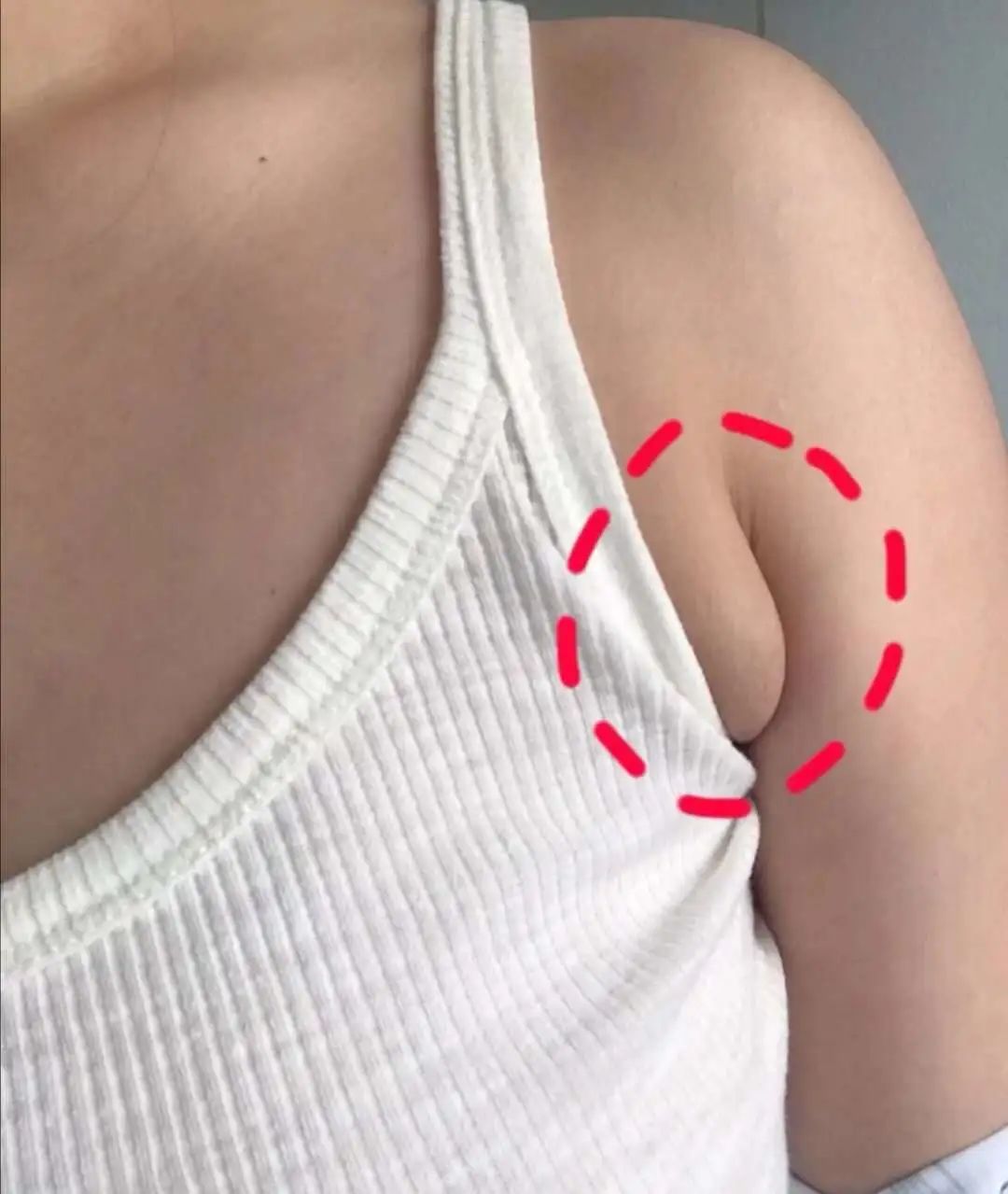 副乳正常照片胳肢窝图片
