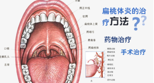 很小的时候扁桃体割了,长大确诊扁桃体增生,还有可能是hpv感染