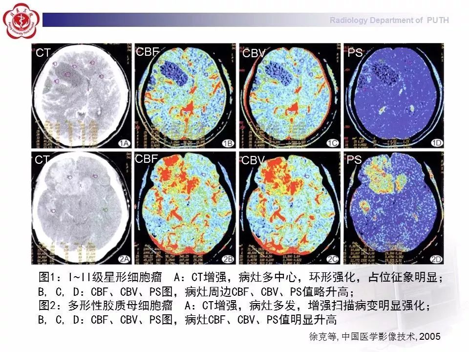 ct灌注成像图像解读图片