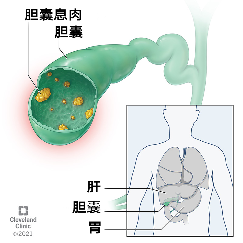 胆囊息肉是怎么引起的图片