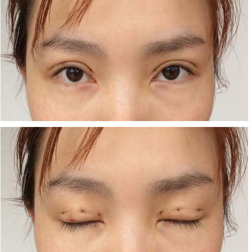 吸雕双眼皮是如何做的呢?有哪些优势?术后如何护理?