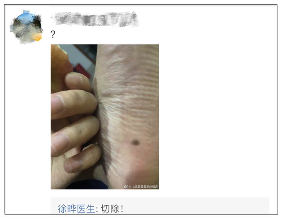推荐速低头，找痣！知名医生：长在这些地方的都要切除！