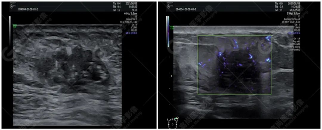 高尚病例浅表超声乳腺癌
