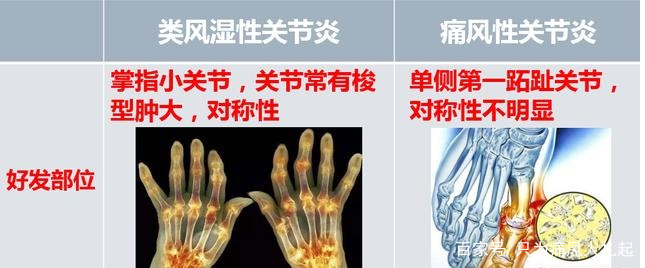 擅長：強直性脊柱炎、類風濕關節炎、痛風性關節炎、骨性關節炎等常見關節炎病，和紅斑狼瘡、...黃牛號販子掛號,圈子口碑最好100%有號!專業的人做專業的事的簡單介紹