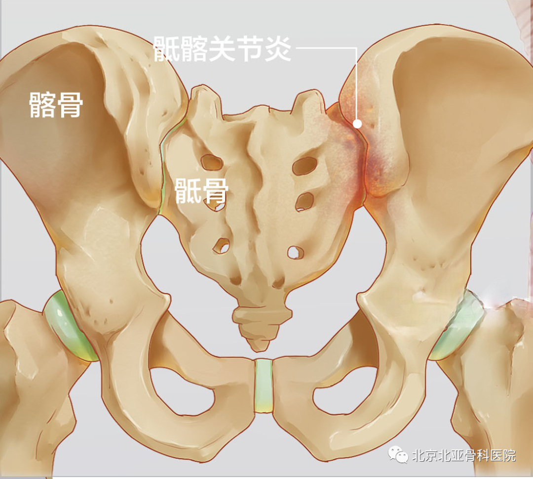 她年纪轻轻却腰臀部疼痛难忍,原因竟然是 "骶髂关节炎"!