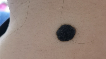 推荐速低头，找痣！知名医生：长在这些地方的都要切除！