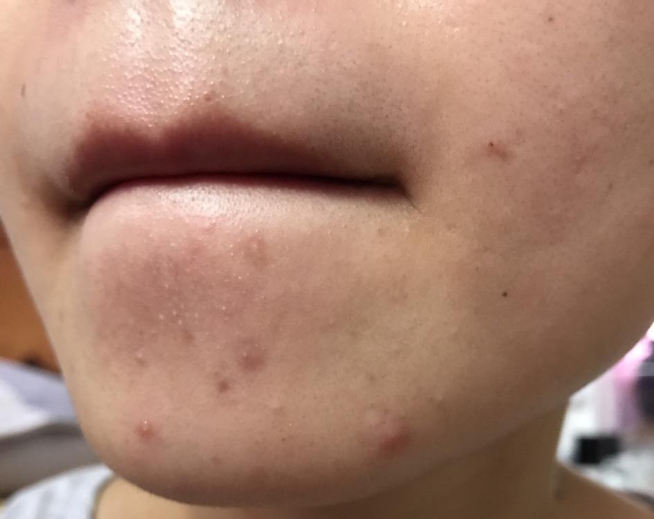 鼻子上挤出来的白色丝状物,是什么东西?可能是虫的分泌物