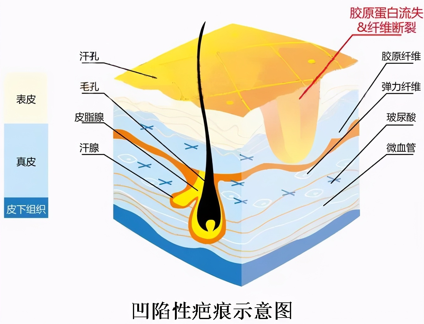 凹进去的疤痕能长平吗 疤.@豆子真的爱护肤的动态