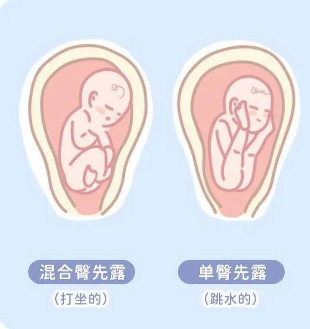 混合臀先露图片图片