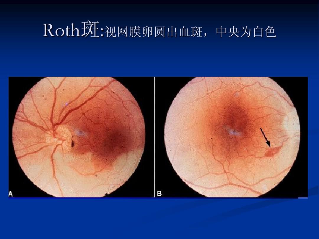 视网膜roth斑图片