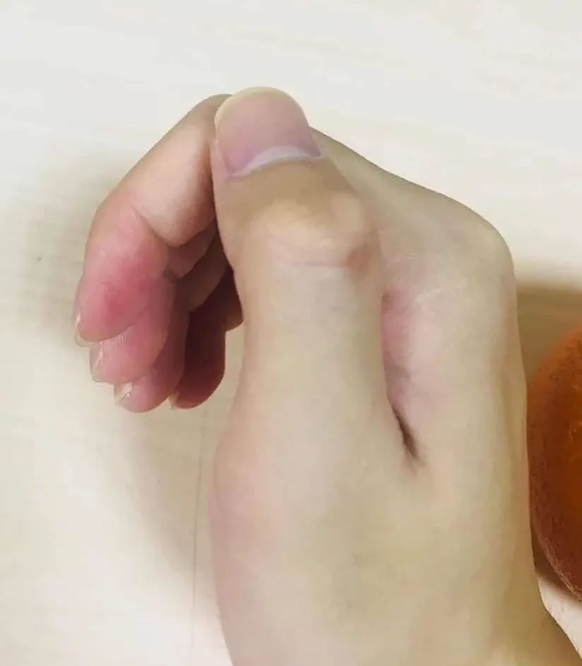 偏瘫后上肢抬不起来没功能,手不会动的阶段性治疗方案,看完有收获