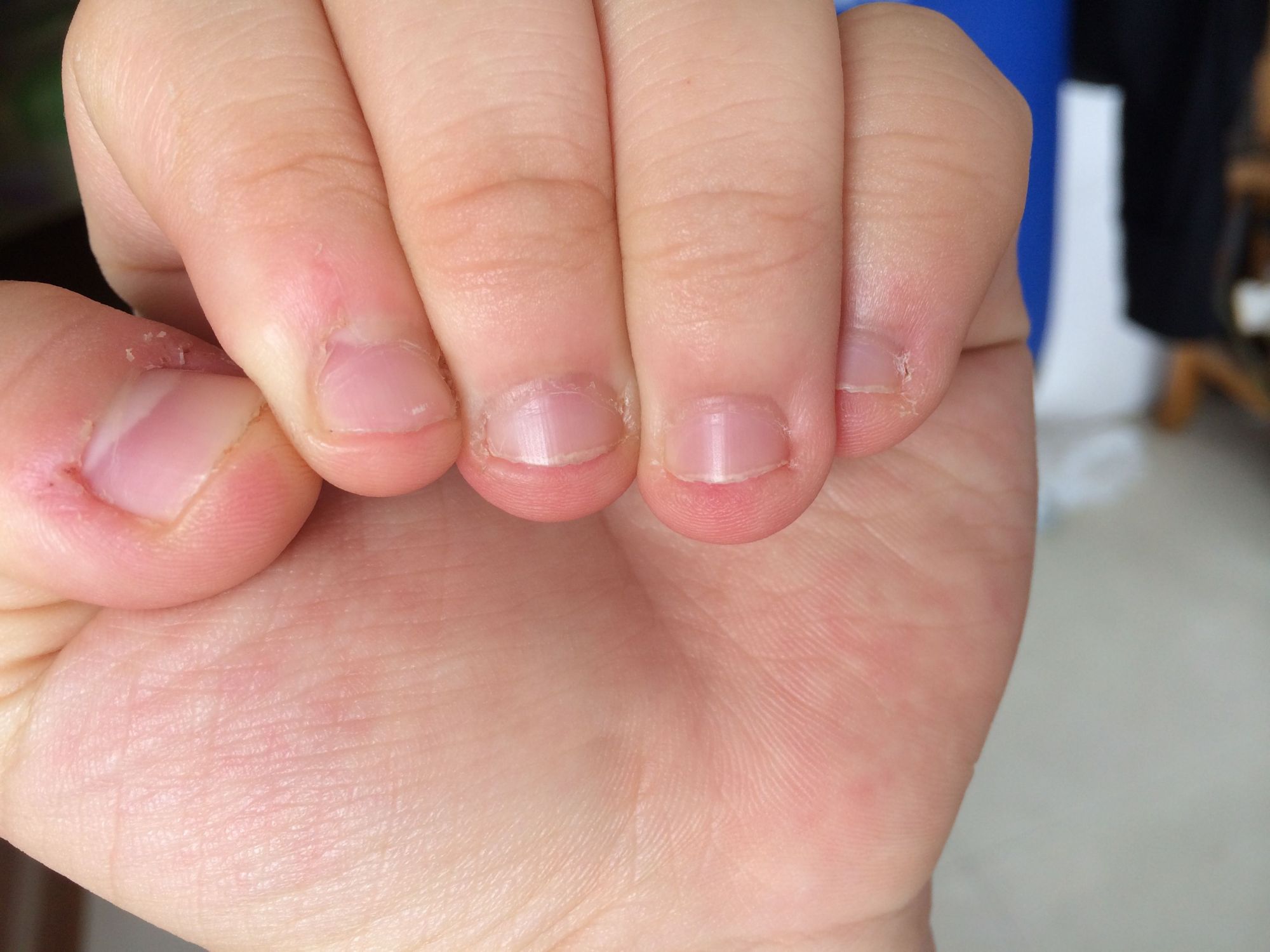 咬甲癖变现为反复咬指甲而不能自控时,建议就医,重者应积极干预