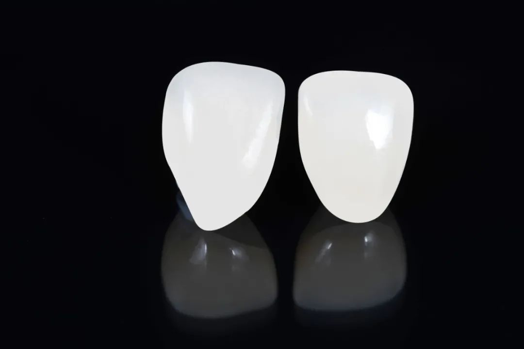 明星都在用的"3d数字化陶瓷贴面",它究竟是什么神器?