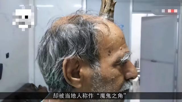 广东107岁老人头上长角!"龙存在"又添一实证?