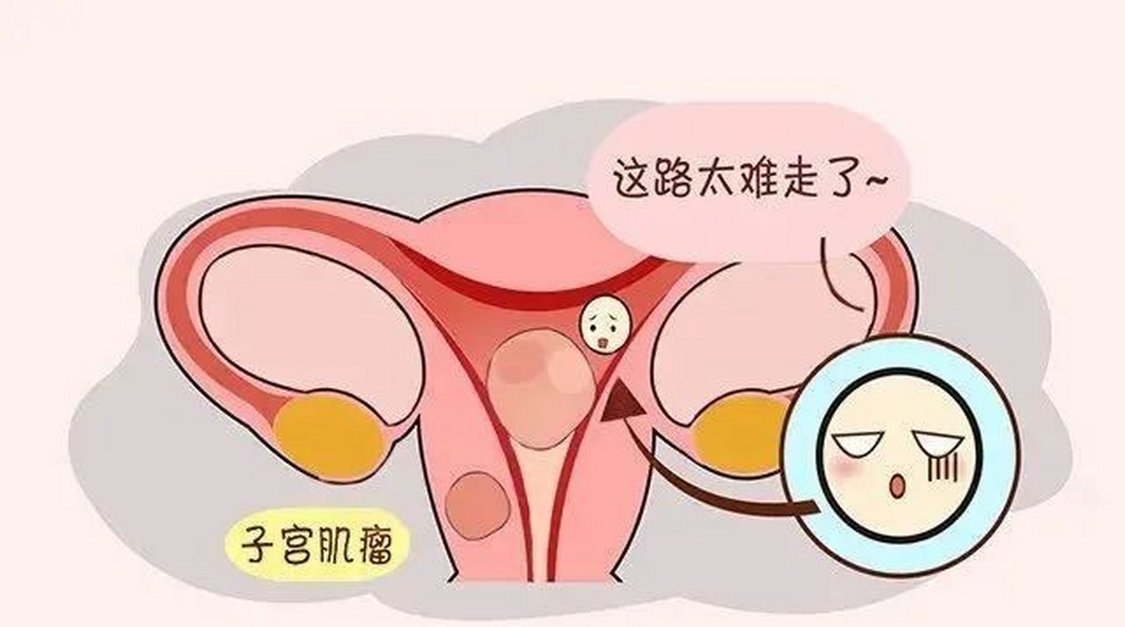 我一直跟她们说这个子宫肌瘤形成的原因很复杂,谁也没办法给你一个
